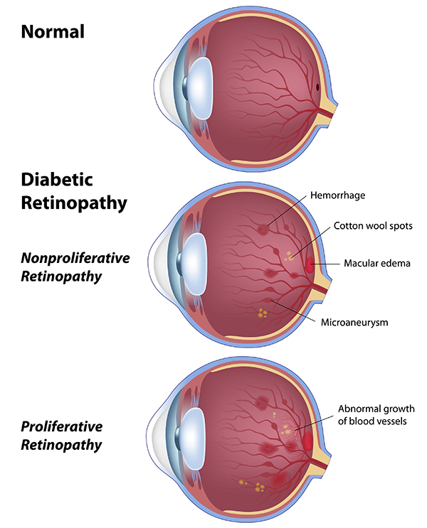 diabetic vision loss in staten island