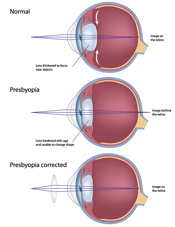 presbyopia in staten island